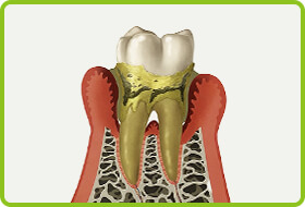 第三段階：中等度の歯周炎