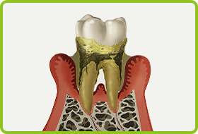 第四段階：重度の歯周炎