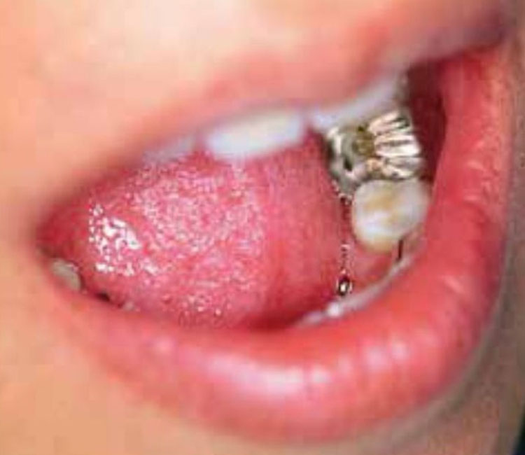 少し口を開けた際、下歯に金属の歯が見える