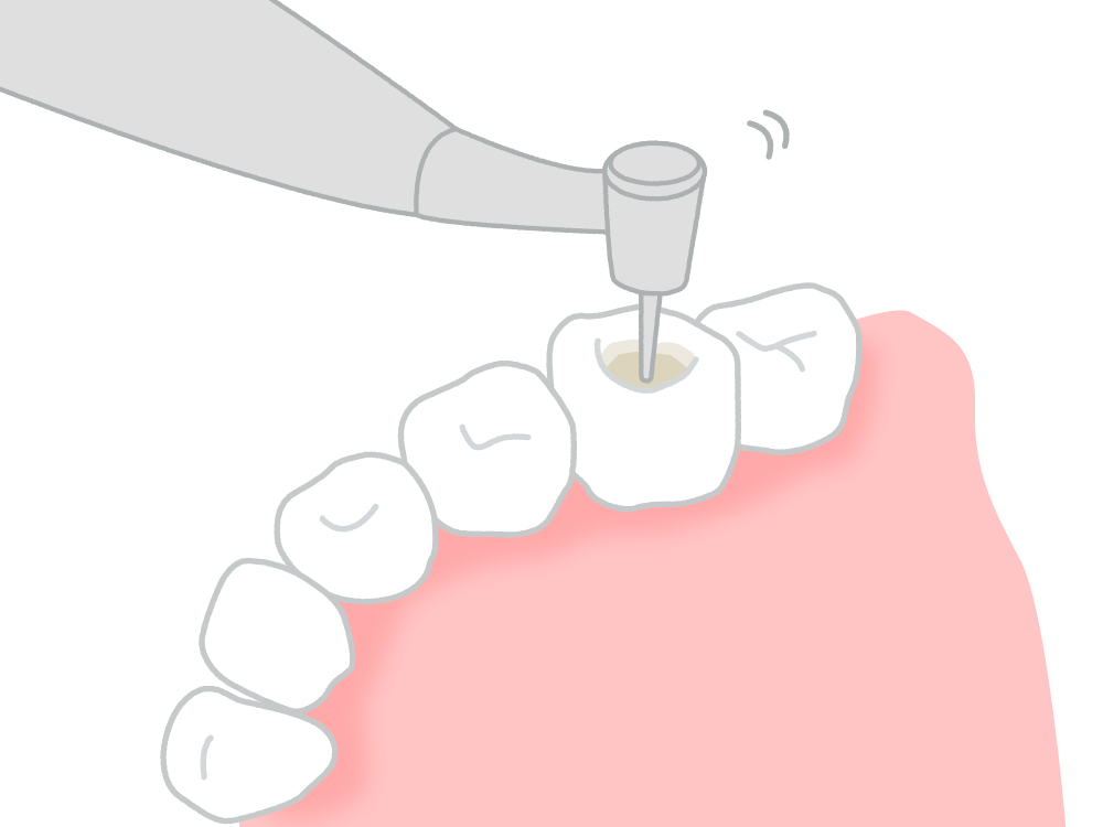 虫歯除去・根管治療