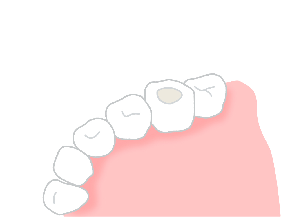 歯の形成